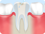 根管の洗浄・消毒